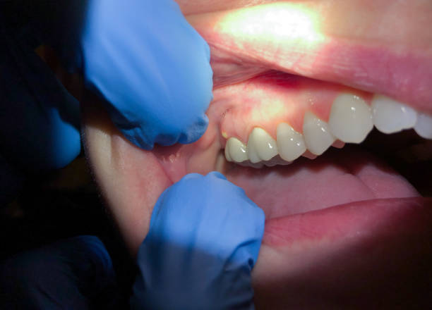 Best Emergency Treatment for Toothache in Gillette, NJ